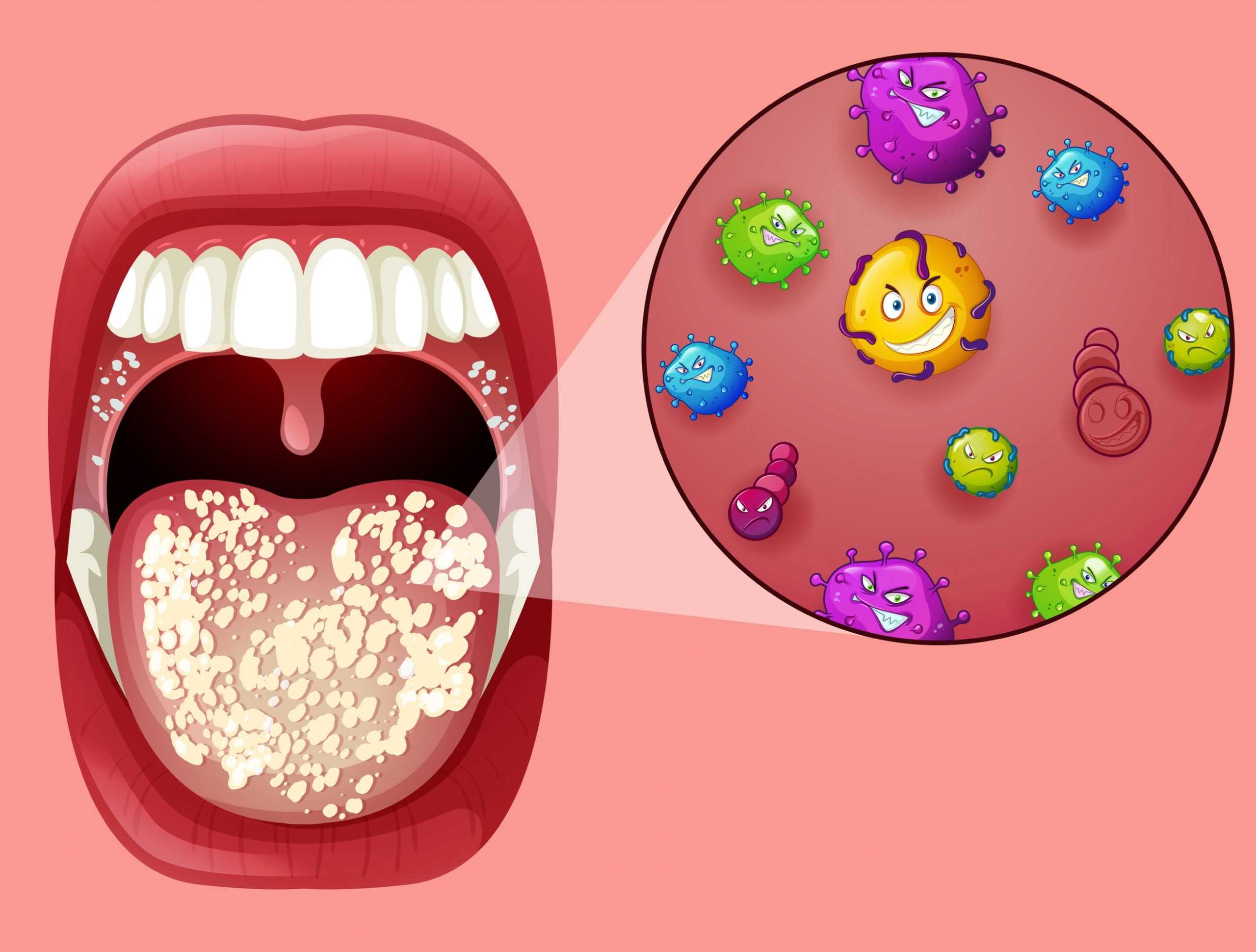 Keto Diet for Candida: Is Ketosis Bad for Candida? Bariatric Station