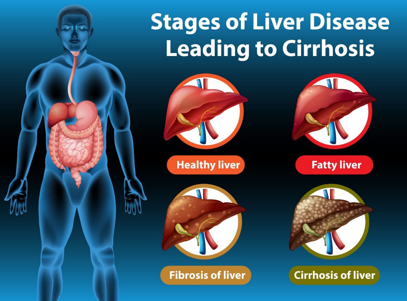 Keto Diet for Fatty Liver Disease: All You Need to Know About NAFLD Bariatric Station